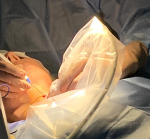 radiofrequency ablation